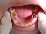 dental caries