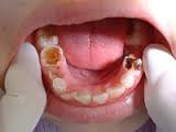 dental caries'