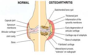 Osteoarthritis and Meniscal Tears'
