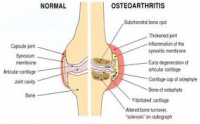 Osteoarthritis and Meniscal Tears
