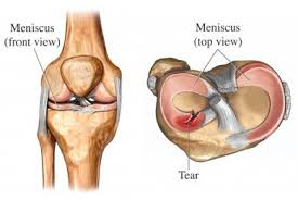 meniscal tear and knee osteoarthritis