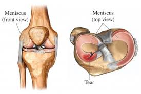 meniscal tear and knee osteoarthritis'