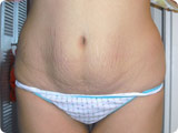 Stretchmark-Treatments.com