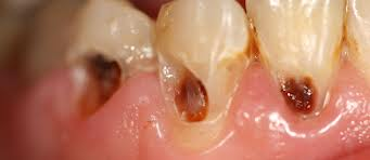 dental caries