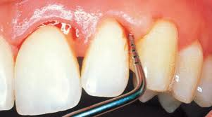 periodontis