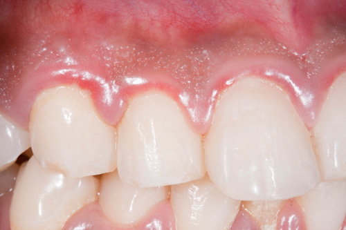 Gum Disease'