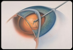 Johnson City Lasik surgeries