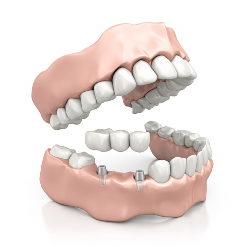 Dental Implants'