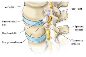 Lumbar disc herniation