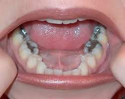 dental amalgam'
