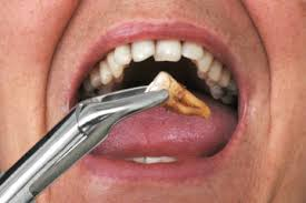 tooth extraction