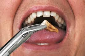 tooth extraction'