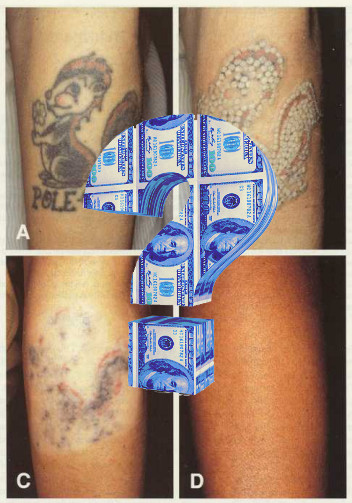 tattoo removal cost'