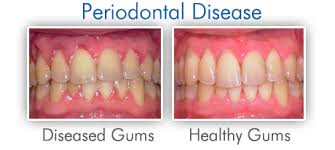 gum disease