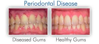 gum disease'