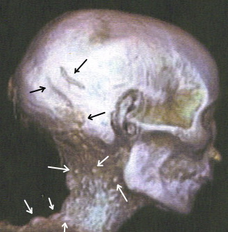 Dr. Joel Klenck: Mummy of Thutmose II.'