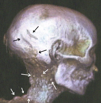 Dr. Joel Klenck: Mummy of Thutmose II.