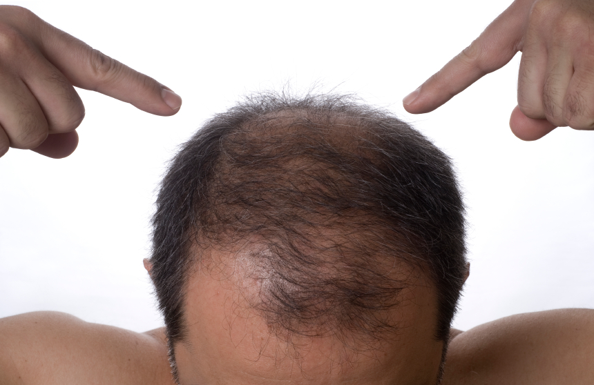 pattern baldness'