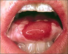 oral complications'