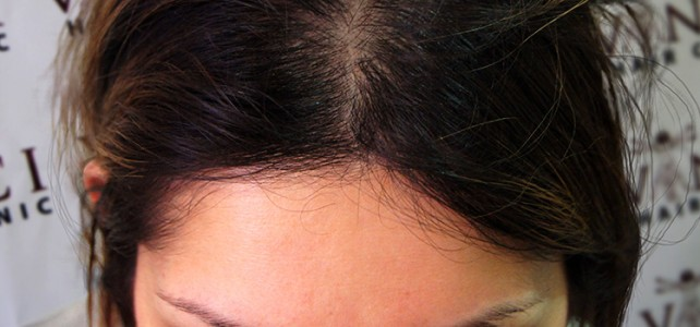 hair transplant for women