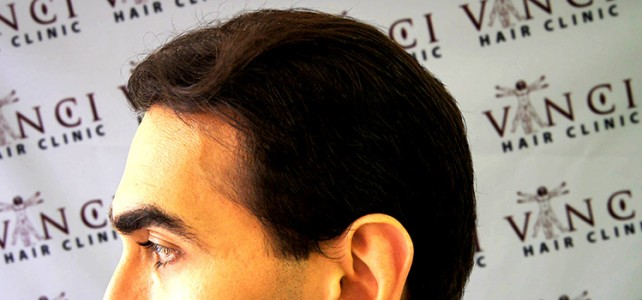 hair transplant for men