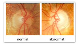 glaucoma eye exam