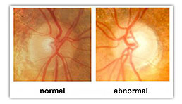 glaucoma eye exam'