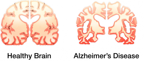 Healthly or Alzheimers'