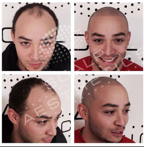 scalp treatment'