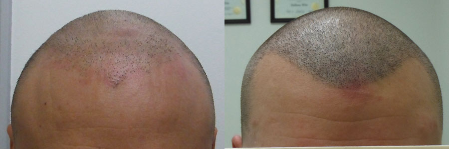 scalp micropigmentation'