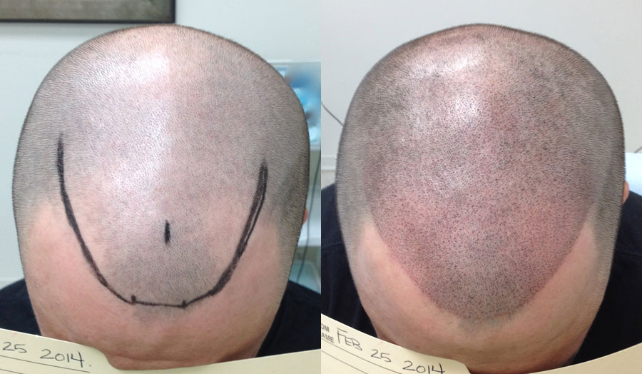 cheap scalp micropigmentation'