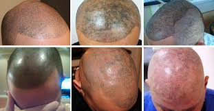 scalp micropigmentation'