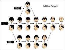 balding pattern'