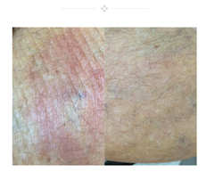 Dermaka, LLC