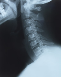 subluxation'