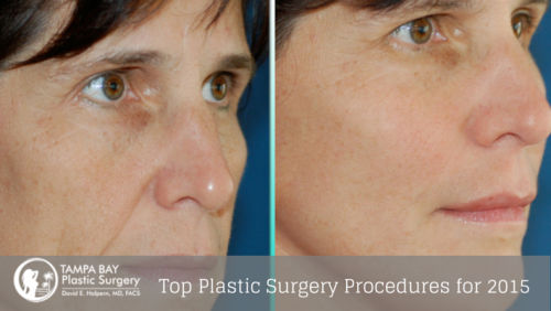 Top Plastic Surgery Procedures for 2015'
