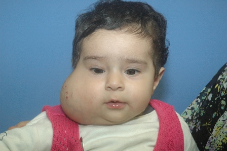 9 month old baby girl presented with large Hemangioma'