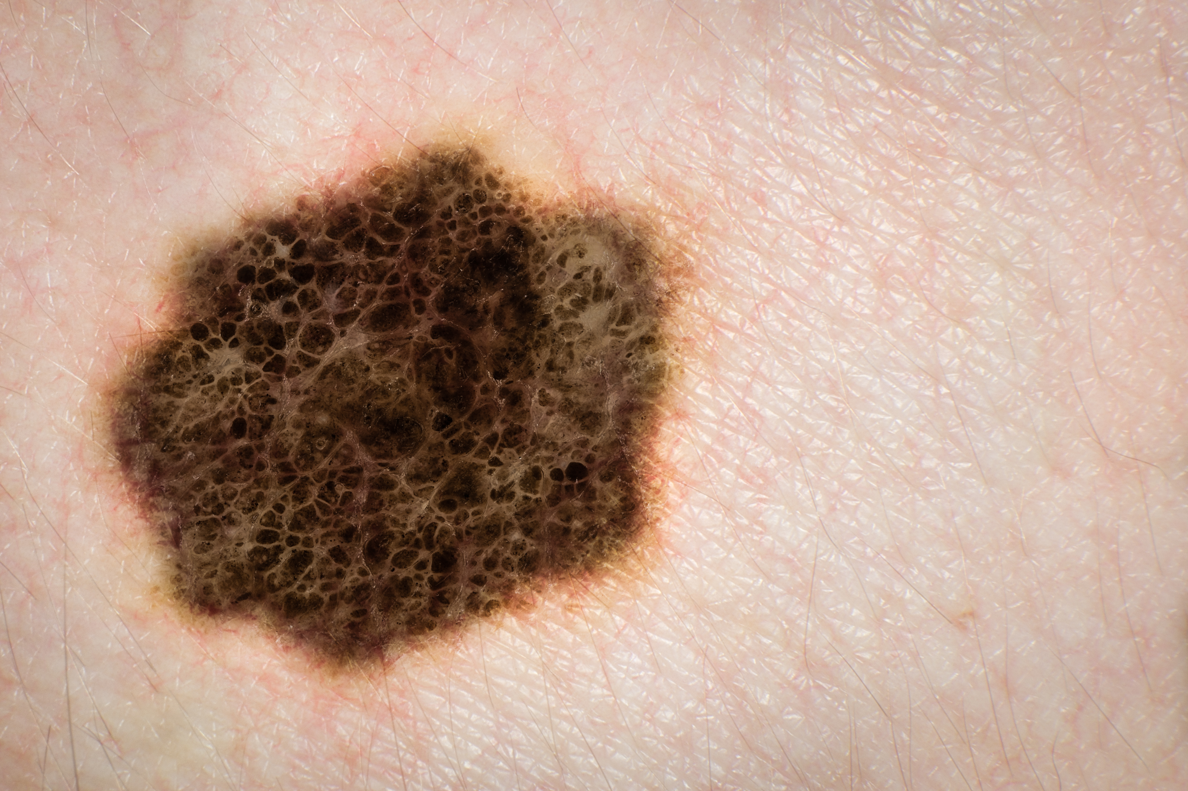 melanoma
