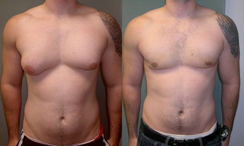 Gynecomaguide