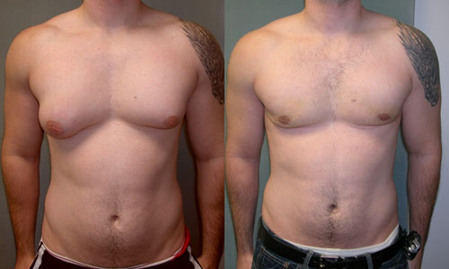 Gynecomaguide'