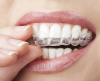 Invisalign clear aligners'