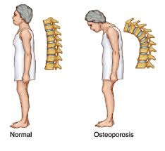 osteoporosis