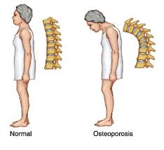 osteoporosis'