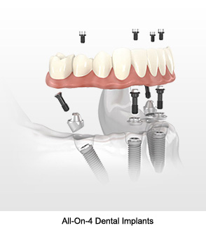 All-On-4 Dental Implants'