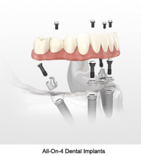 All-On-4 Dental Implants