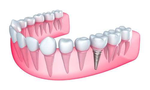 Dental Implant'