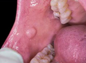 Oral Cancer Lesion'