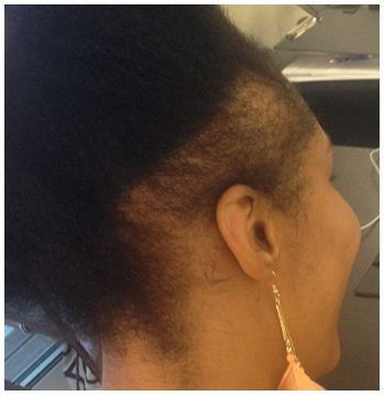 FUE Hair Transplant Clinics'