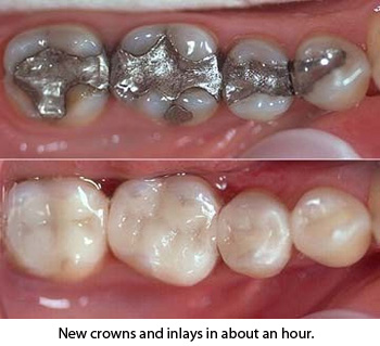 New crowns in about an hour