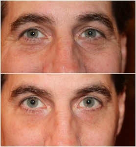 Better than Botox Bash'